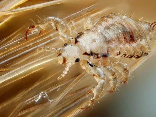 Makroaufnahme einer hellen Kopflaus, die sich mit ihren Krallenbeinen zwischen menschlichen Haaren festhält.